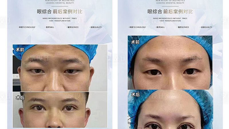 医美咨询师新手实战技巧：如何精准把握客户需求