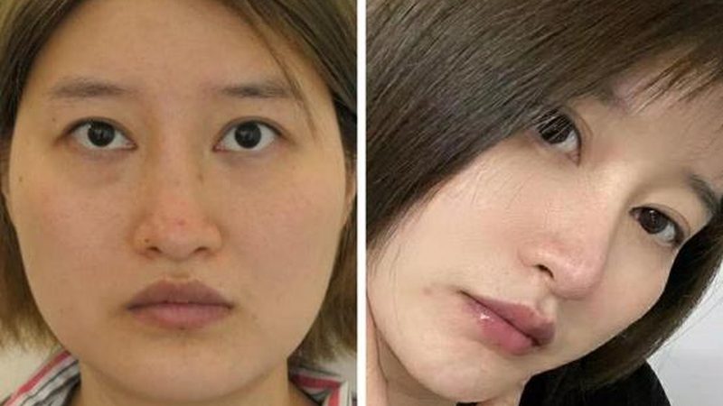小标题：注射美容与线雕的区别