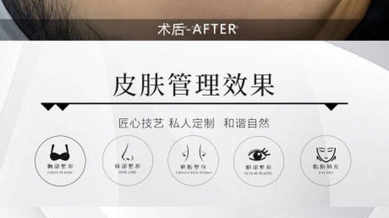 埋线提升步骤详解：揭开面部年轻化的神秘面纱