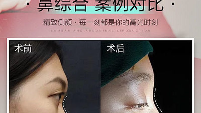 小标题：双眼皮修复手术的注意事项