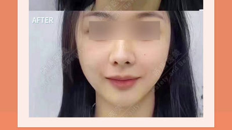 打了瘦脸针又长回来，是反弹还是你想错了