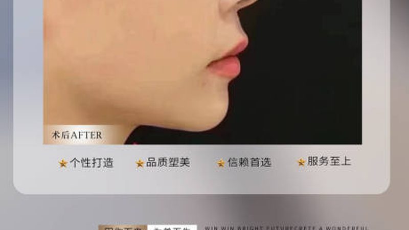 激光美容去红血丝，价格背后的考量因素